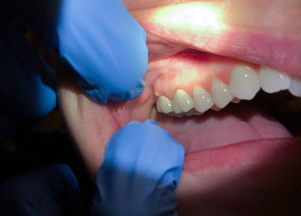 Best Emergency Gum Treatment in Clton, IN