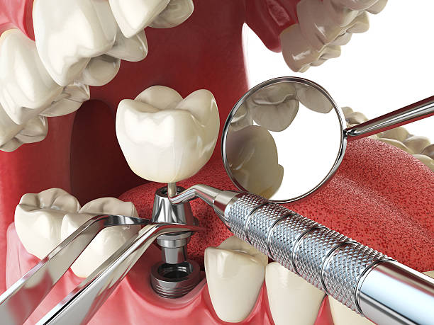 Best Emergency Root Canal Treatment in Clton, IN