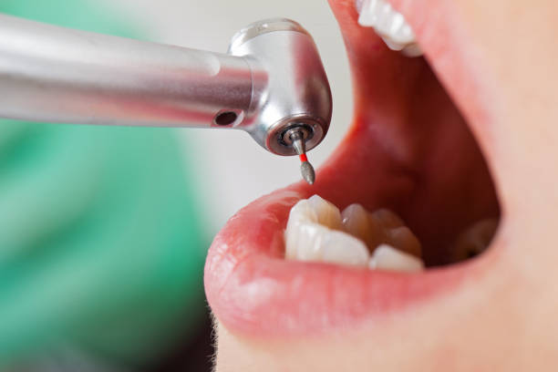 Best Emergency Tooth Extraction in Clton, IN